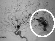 Angiografia carotídea perfil mostrando a MAV.