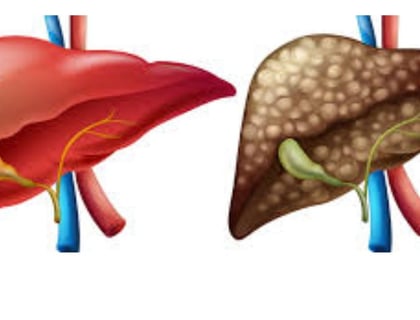 _Beware of the inevitable fate of fatty liver,fibrosis , cirrhosis, esophageal varices and hepatoma