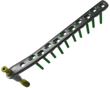 Placa para Fémur Distal Condylar DCS 95°