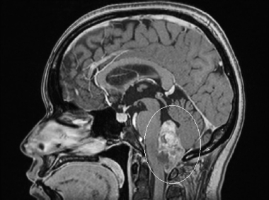 Ressonância de paciente com cefaleia e vômitos com volumoso tumor no cerebelo antes da cirurgia.