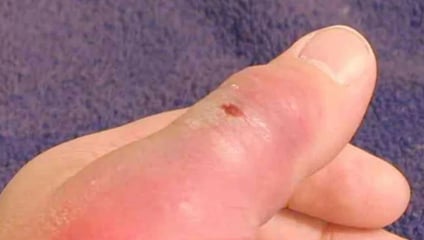 Treatment option , Symptoms