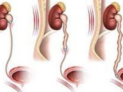 ureteric stone