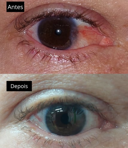 foto mostrando o antes e depois de uma cirurgia de pterigio