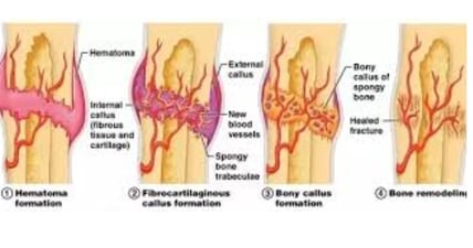 bone healing stages