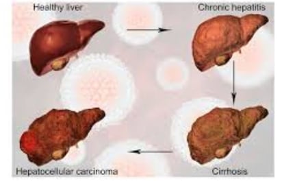 fatty liver,fibrosis , cirrhosis, esophageal varices and hepatoma