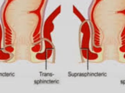 The use of honey in the management of anal fistulas may reduce pain and facilitate healing