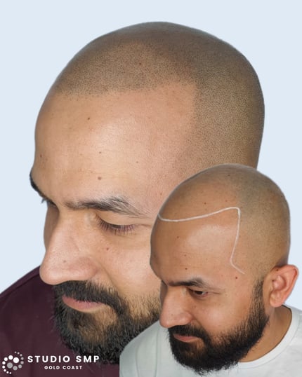 Scalp Micropigmentation (SMP)