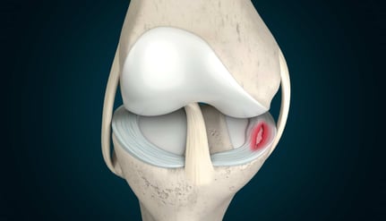 Meniscus Tear- Dr. T. Aravindh MBBS, MS( ORTHO)