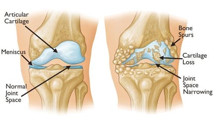 Arthritis / Osteoarthritis- Dr. T. Aravindh MBBS, MS( ORTHO)