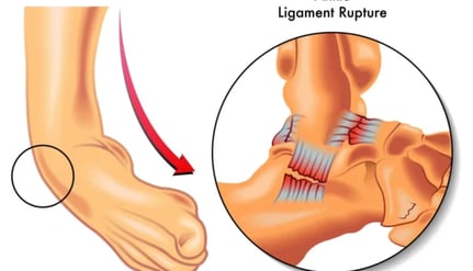 Ligament Injury- Dr. T. Aravindh MBBS, MS( ORTHO)