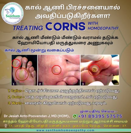 Foot Corn Homoeopathic medicine