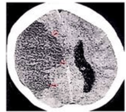 stroke ct