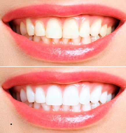 Close-up of a radiant smile after teeth whitening, showcasing bright, white teeth.