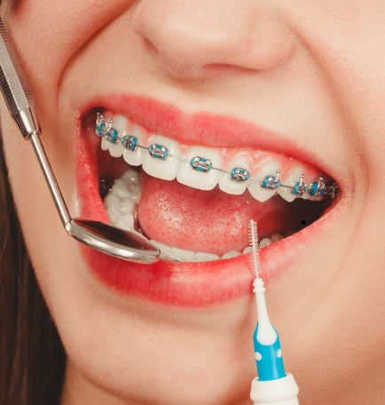 Close-up of traditional metal braces on teeth, demonstrating effective orthodontic treatment