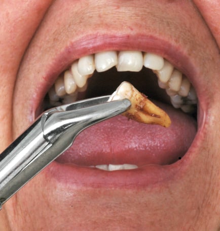 dentist carefully extracting a damaged tooth using dental instruments in a clinical setting."