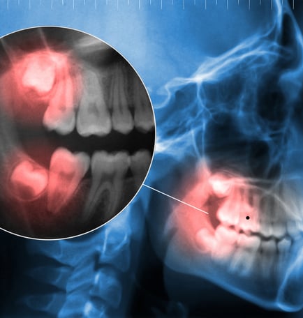 Close-up of a patient receiving dental examination for a painful toothache