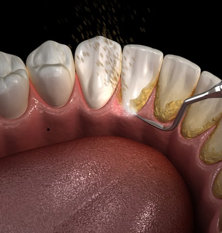 Dentist using specialized tools for scaling and root planing to treat gum disease