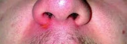 nose inflammation