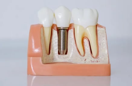 Mejores Implantes dentales en Sevilla
