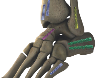 Tornillo Canulado de Doble Compresión
