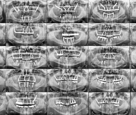 all-on-x panoramic x-ray