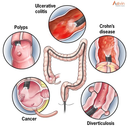 a colon with reasons of why colonoscopy is done