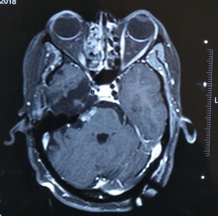 Residual tumour, which was then treated with Radiosurgery