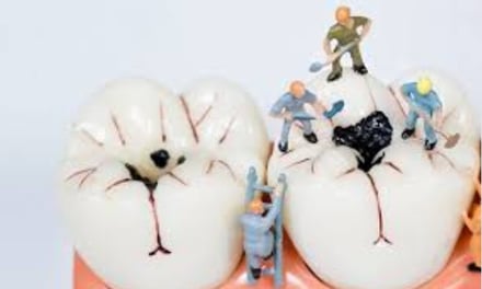 caries