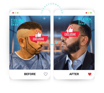 Celebrities Beard Transplant