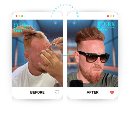 Celebrities Hair Transplant