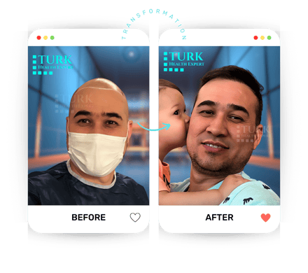 Celebrities Hair Transplant