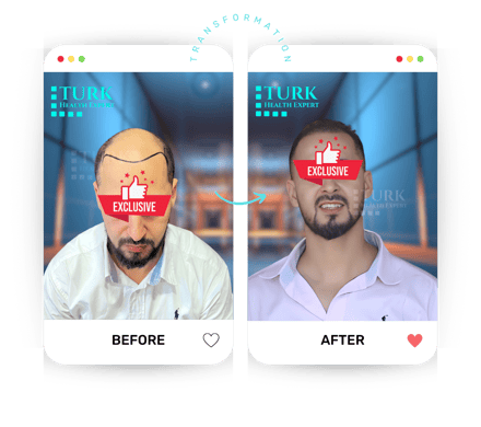Celebrities Hair Transplant