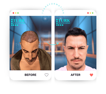 Celebrities Hair Transplant