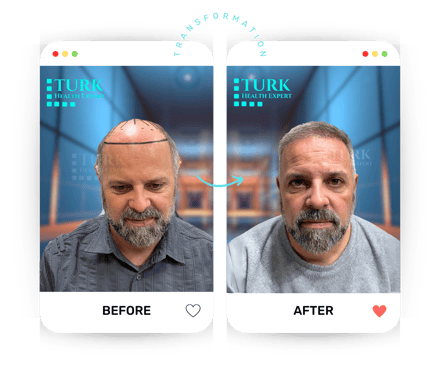 Celebrities Hair Transplant