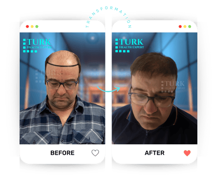 Celebrities Hair Transplant