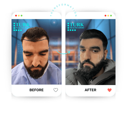 Celebrities Hair Transplant