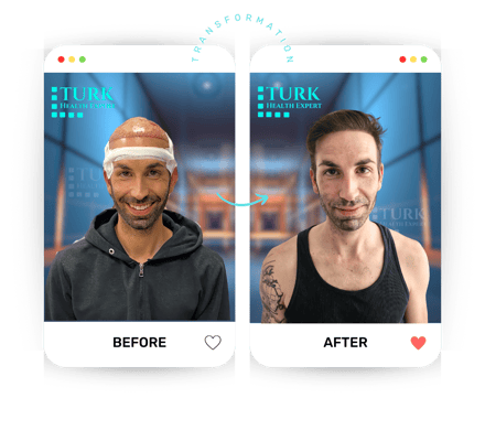 Celebrities Hair Transplant