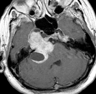 Pre-operative MRI 