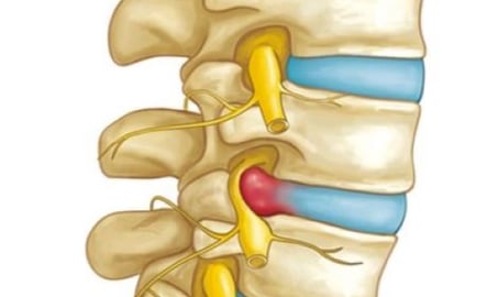 Lumbar Spine & Prolapse -Dr. T. Aravindh MBBS, MS( ORTHO)