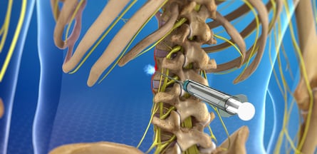 Nerve Blocks-Dr. T. Aravindh MBBS, MS( ORTHO)