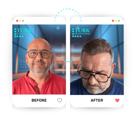 Celebrities Hair Transplant