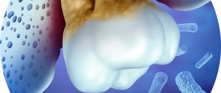 parodontite avant et après traitementsoins jet dentaire ozone hygiene-precision.com