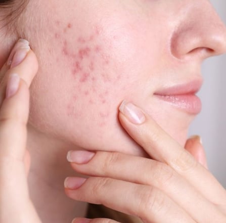 woman with acne
