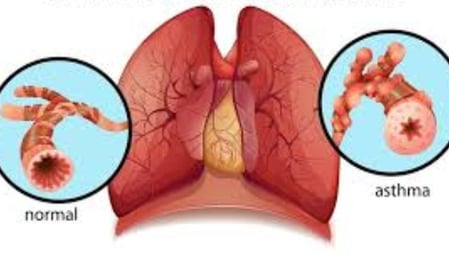 Bronchial asthma