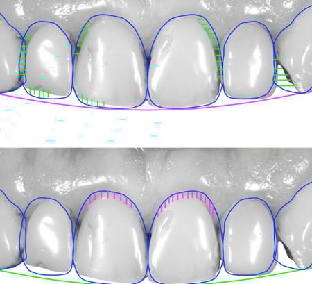 Digital smile design (DSD)