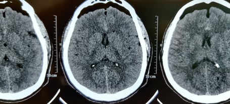 Postop CT Scan-Complete removal of the colloid cyst