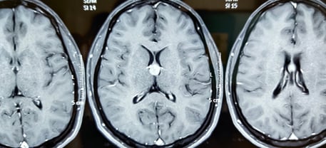 Preop MRI- Colloid cyst in the third ventricle