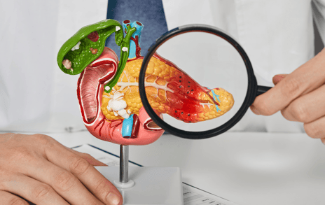 Ca Pancreas