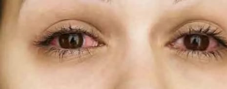 honey in eyes to improve eyesight Anti-inflammatory Antimicrobial Wound-healing Soothing