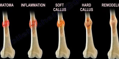 bone healing stages and precess
